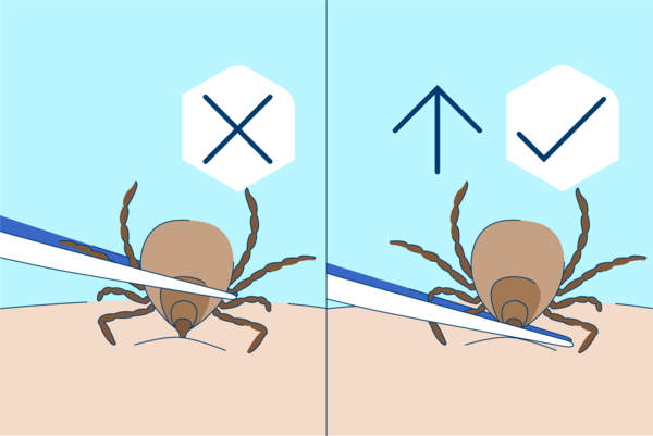 Illustration einer Zecke die mit einer Pinzette entfernt wird