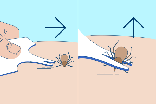 Illustration einer Zecke die mit einer Zeckenkarte entfernt wird